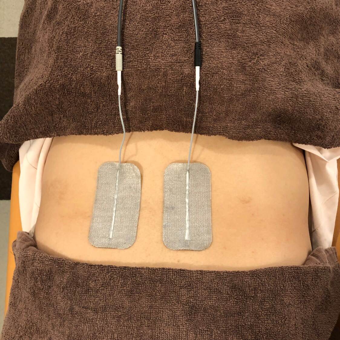 高電圧電気刺激療法・マイクロカレント療法の写真